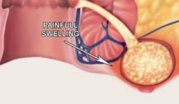 Drenaje de Abscesos anales