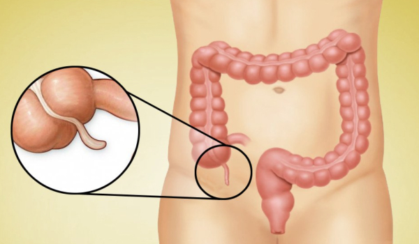 Cirugía de Apendicitis Aguda