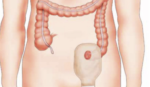 Cirugía de Restitución del Tránsito Intestinal