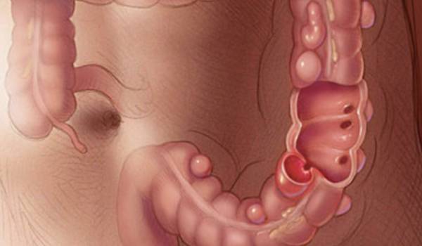 Diverticulitis aguda del colon