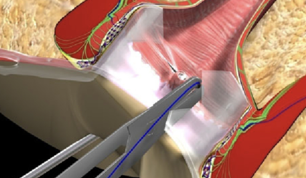 Cirugía de Fistula Anal Resolución.jpg