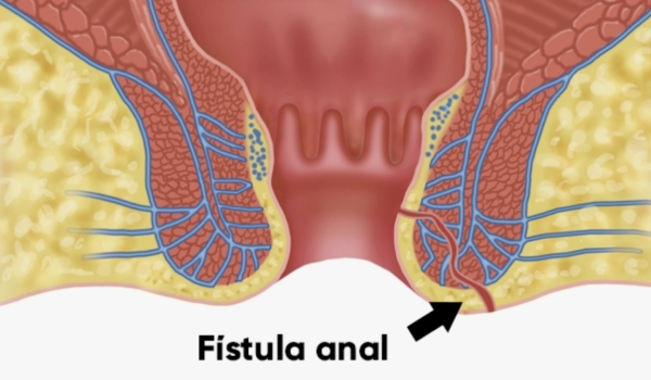 Cirugía de Fistula Anal