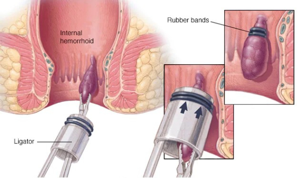 Ligadura de hemorroides internas con banda elástica