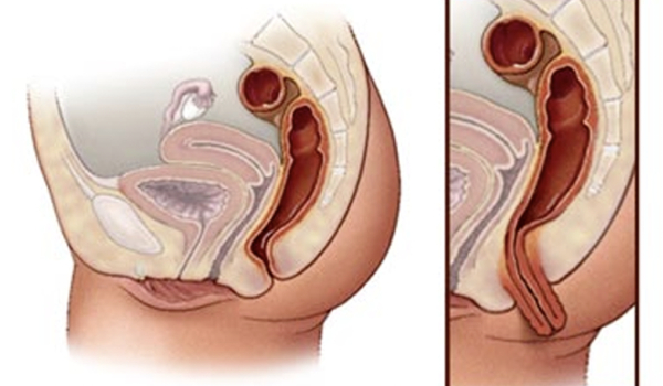 Cirugía del Prolapso Rectal