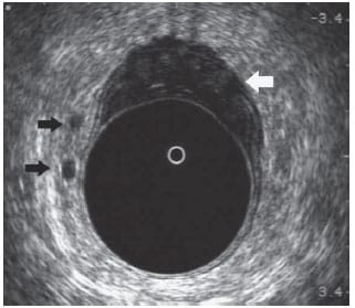 Ultrasonido endoanal y endorectal