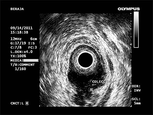 Ultrasonido endoanal y endorectal