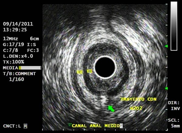 Ultrasonido endoanal y endorectal