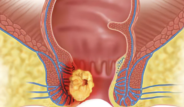 Ultrasonido Perianal